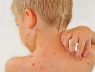Viral Infections That Produce Rashes