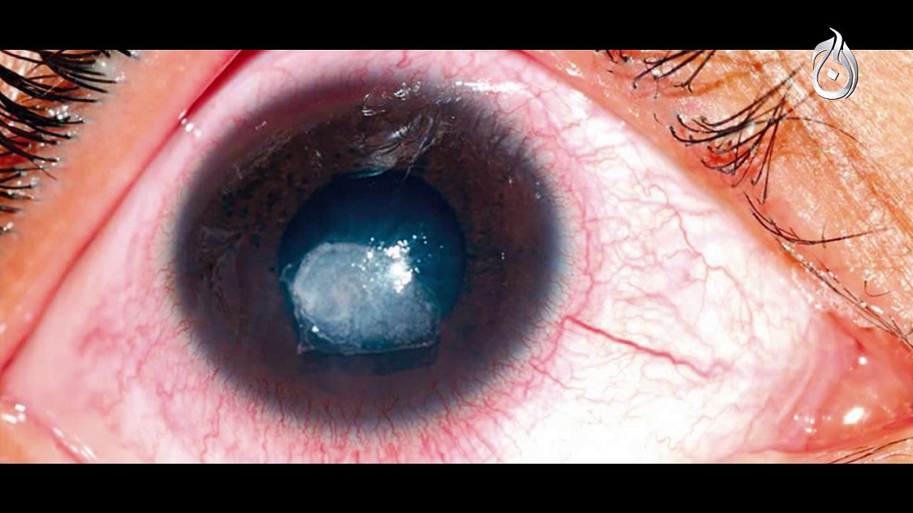 Eye Infection