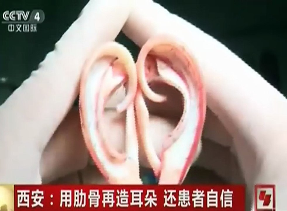 Successful Artificial Ear Surgery