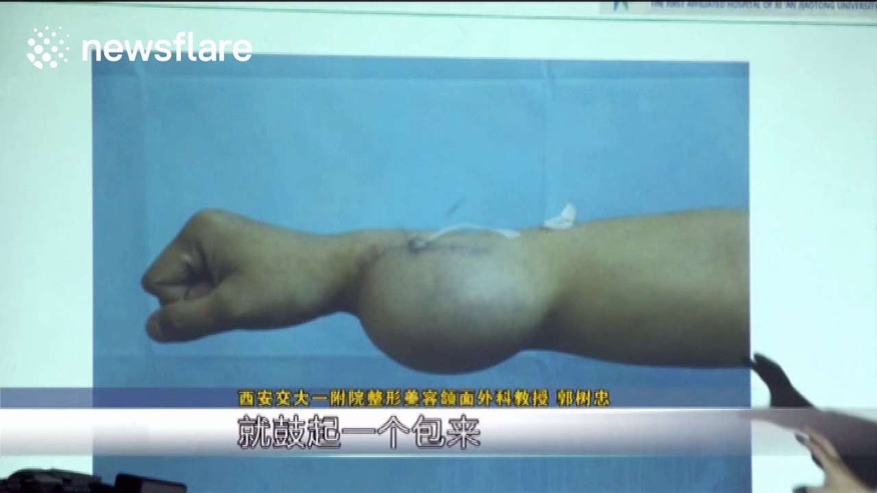 Doctors grow ear on man's arm after he lost an...