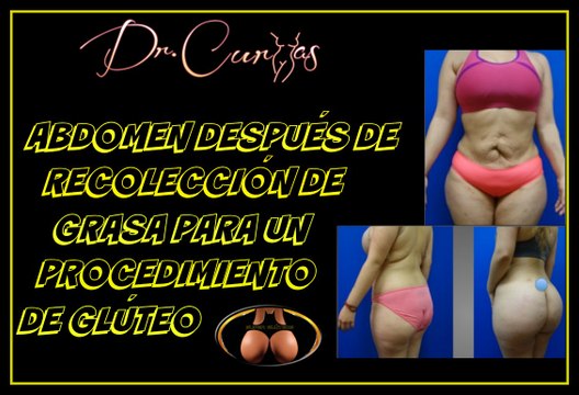 Cómo se verá tu abdomen después de recolección de grasa para un procedimiento de glúteos