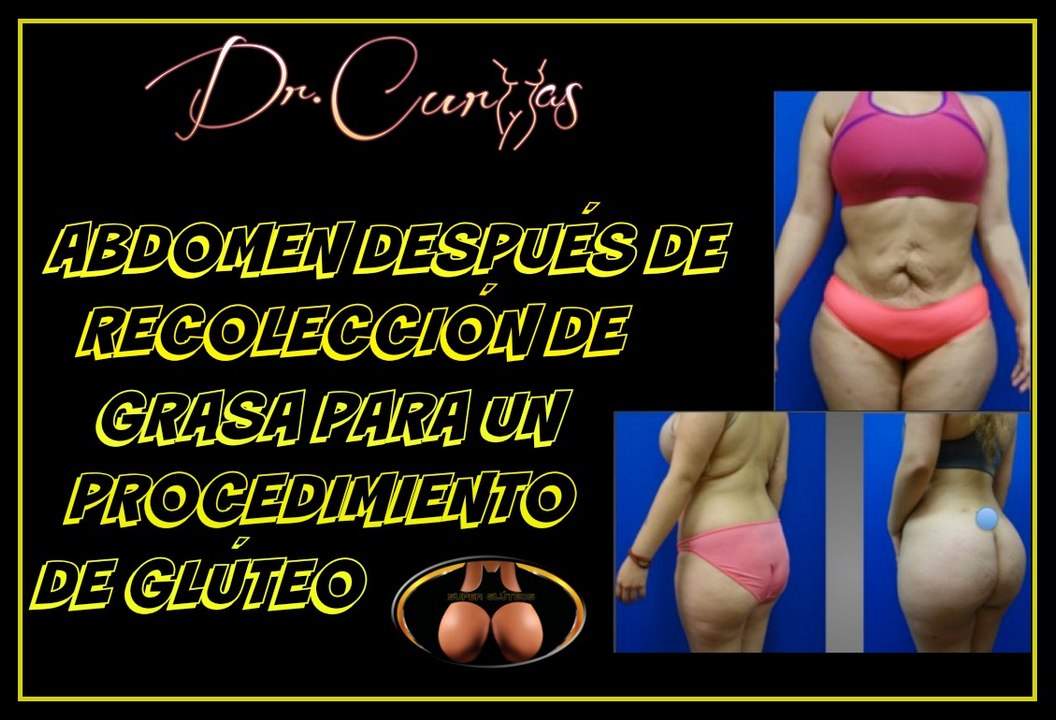 Cómo se verá tu abdomen después de recolección de grasa para un procedimiento de glúteos