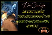Liposucción para recolección de grasa para un procedimiento de mejoramiento de glúteo