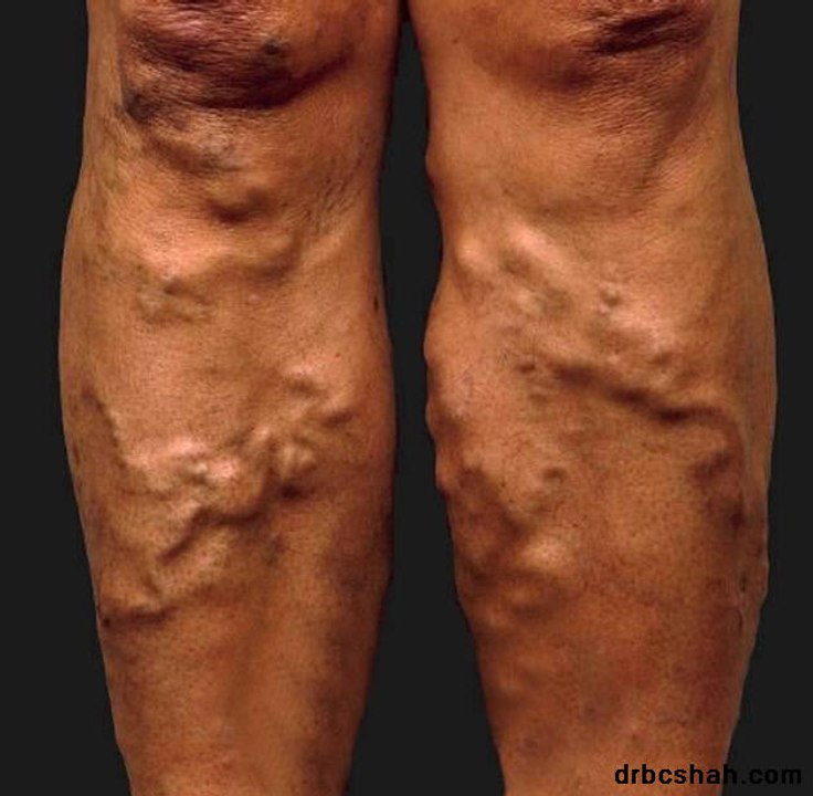 How to Get Rid of Varicose Veins on Legs