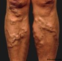 How to Get Rid of Varicose Veins on Legs