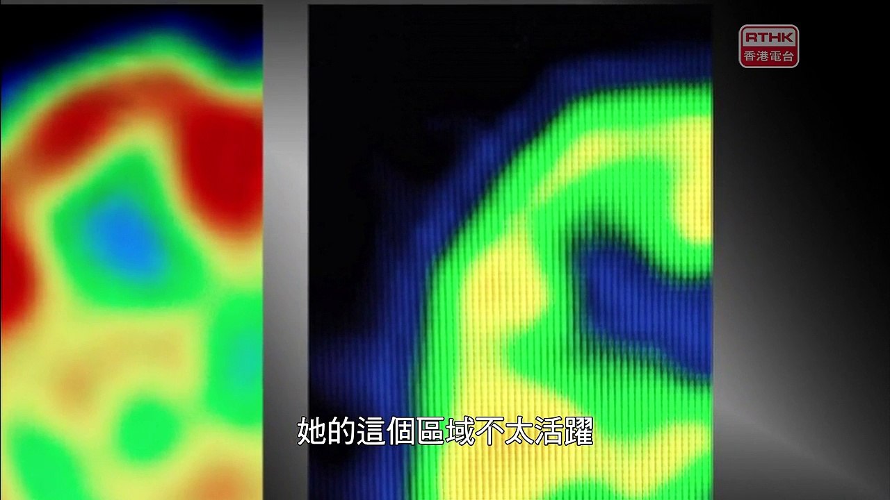零距離科學 2 _2016-11-11_醫學革命 - 根治腰背痛