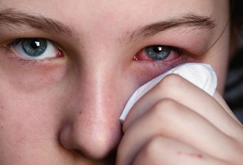 Home Remedies for Conjunctivitis