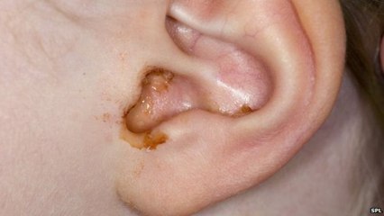 Earwax Blockage or Earwax Impaction