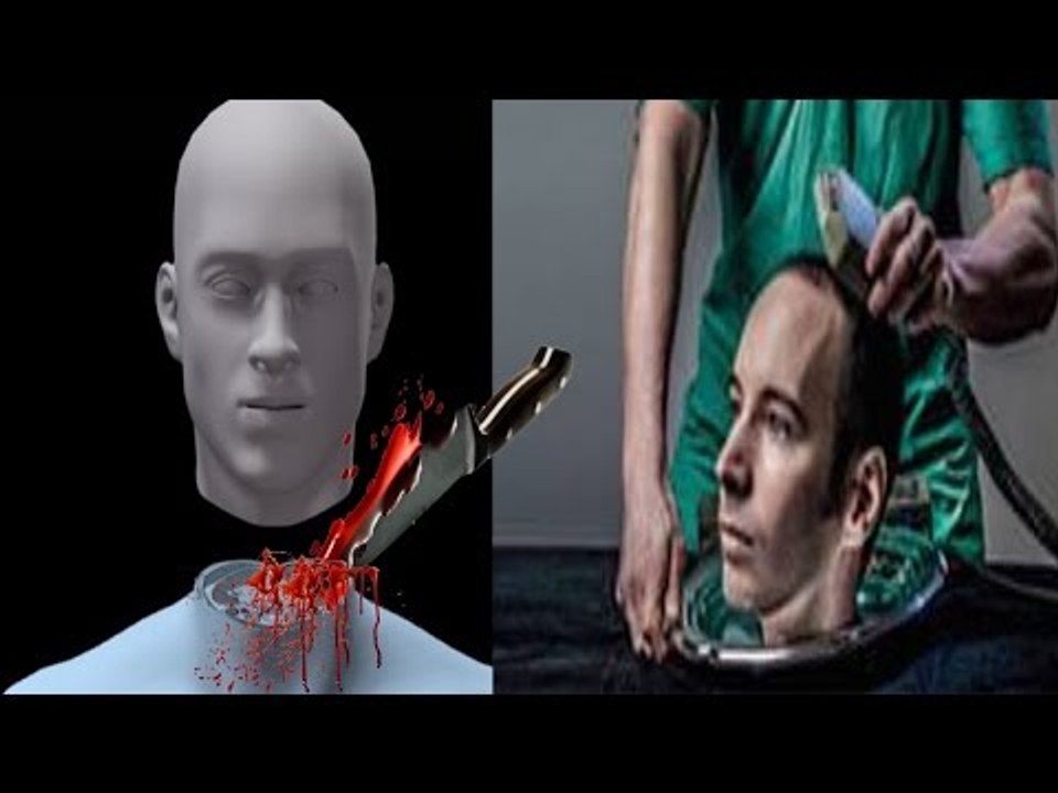 İnsandan İnsana Kafa Nakli Mümkün mü?