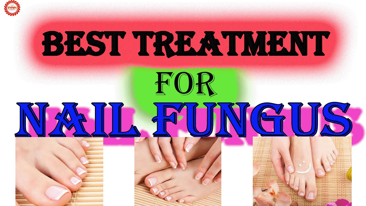 Best Treatment of Nail Fungas | Vinegar As a Toenail Fungus Treatment | Fast Cure For Toenail Fungus