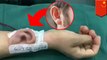 Dokter membuat telinga baru menggunakan lengan pasien - Tomonews