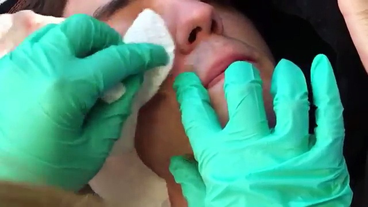 Elle perce un bouton sur le visage de son amoureux, mais ce qui en sort? OH MON DIEU!!!