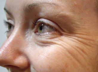 How to Get Rid of Wrinkles Under Eyes Naturally