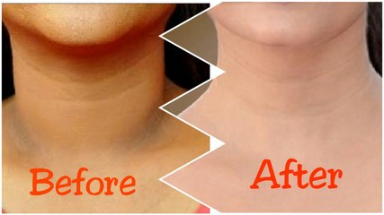 How to Get Rid of Black Neck in 2 Days