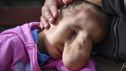 Elle prend sa revanche sur la vie après avoir grandi avec une hernie sur le visage