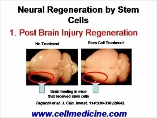 Stem Cell Therapy for Multiple Sclerosis