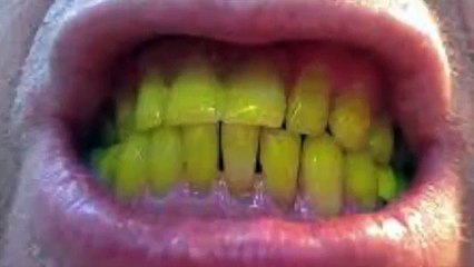 Wrap your teeth with foil and you will not believe the results!