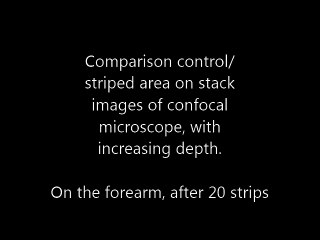 Confocal microscopy results of tape stripping