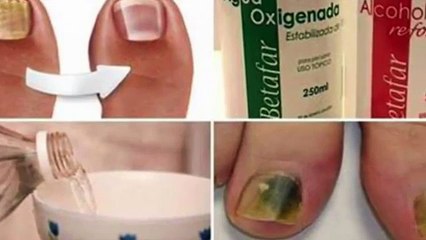 37. They call it the 'fungal killer '. Kill the nail fungus in one pass. AWESOME