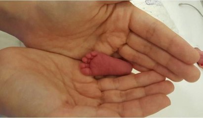 Üçüz parmak bebekler sağlığına kavuştu