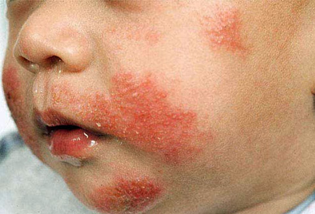 Natural Treatments for Shingles