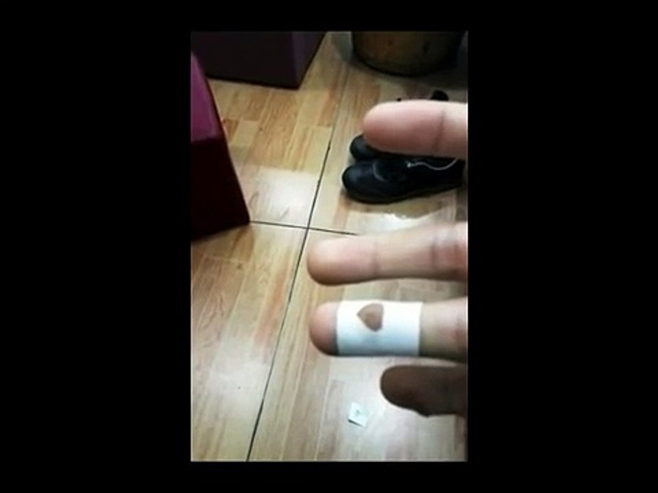 Professional Hand Care (1) Removal of Hard Skin and Treatment of Verruca Vulgaris (Common Warts)