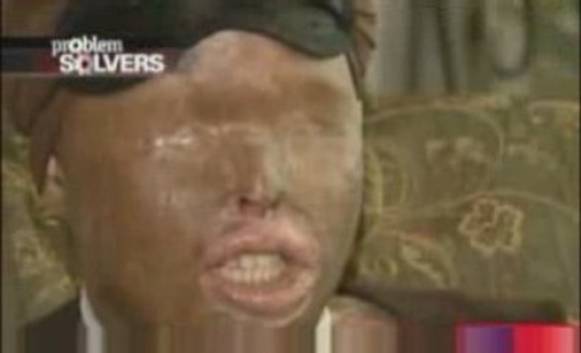 Acide de Piles sur  le Visage