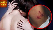 Teen DIES After Girlfriend's Hickey Forms Blood Clot! | Weird Asia