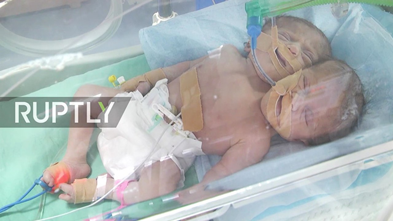 Un enfant à deux têtes voit le jour à Gaza