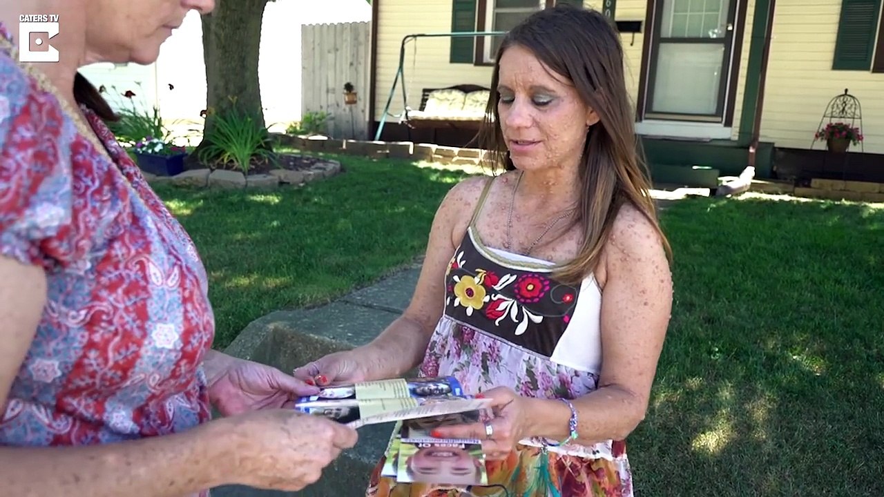 She Had A Happy, Normal Life, Then Her Body Became Covered In Small Bumps