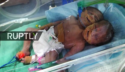 Un bébé avec deux têtes vient de voir le jour en Palestine
