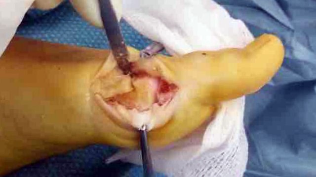 ¿Qué son los juanetes? Cómo tratarlos y curarlos