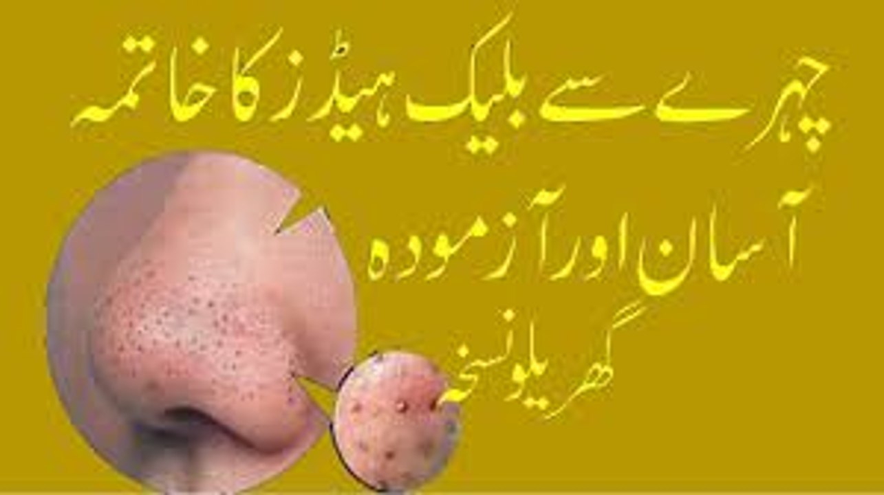 Blackhead Khatam Karne Ka Asan Gharelu Ilaj  How to Remove Blackheads From Nose & Face