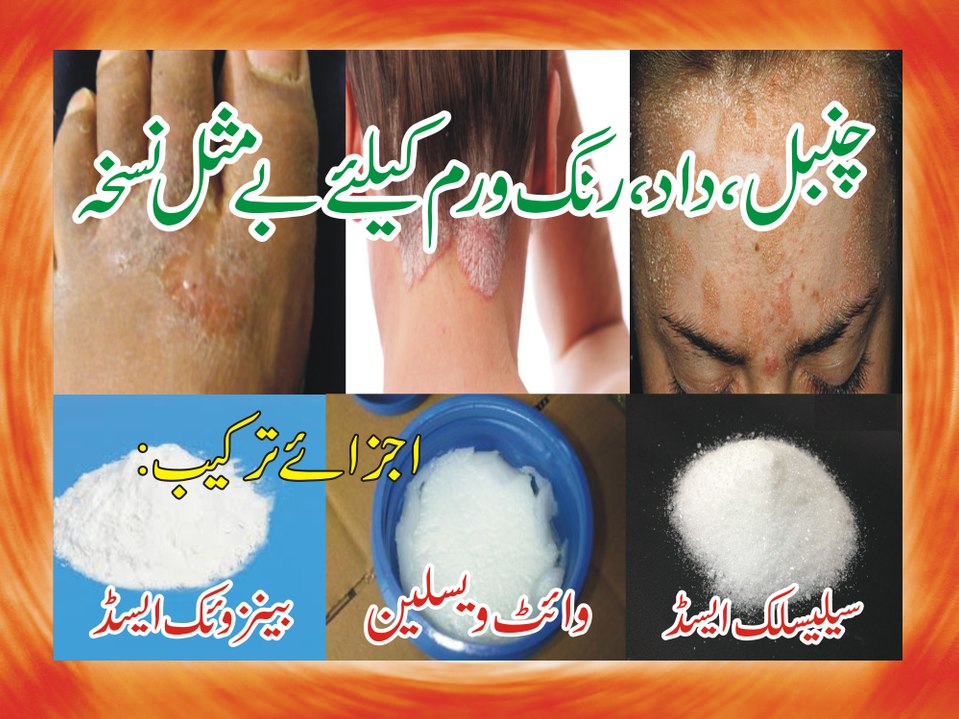 How to get rid of ringworm | Dadri aur chambal ka shafi elaaj