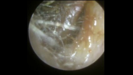 Where To Get Microsuction Ear Wax Removal South Kensignton