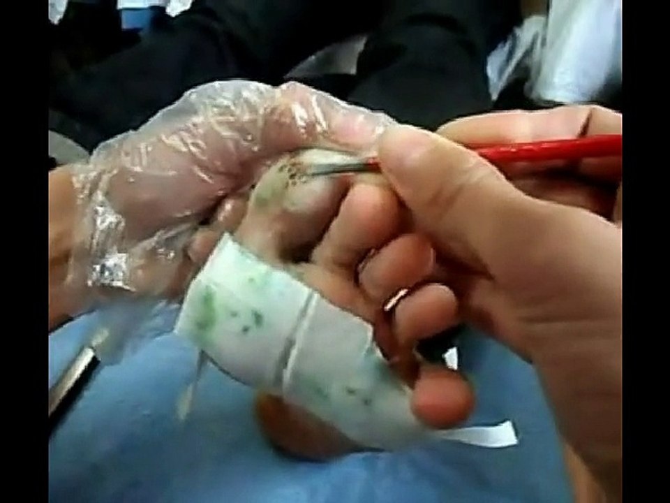 Professional Foot Care (22) Relaxation and Treatment of Plantar Warts