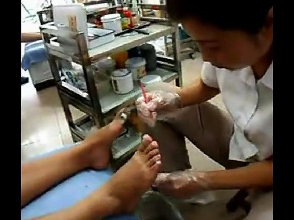 Professional Foot Care (27) Treatment of Foot Diseases and Nail Fungus