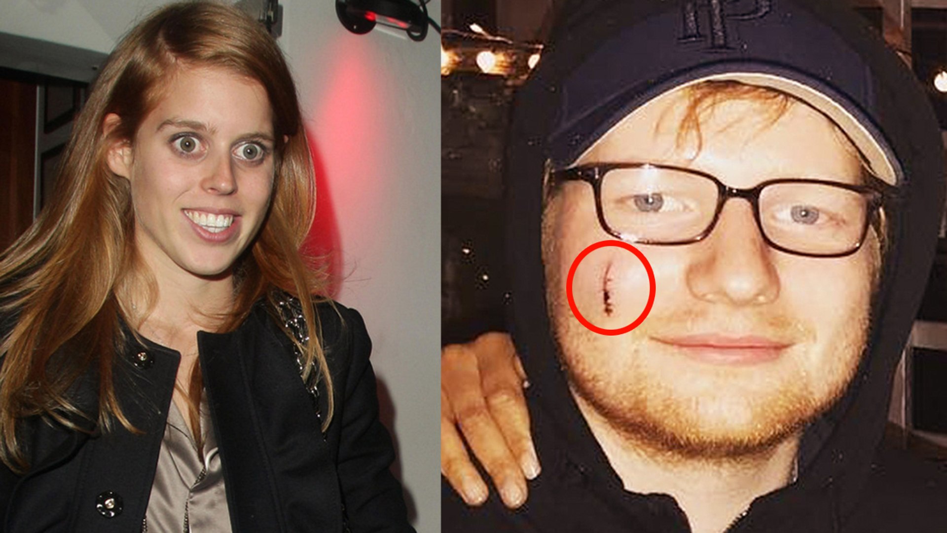 Ed Sheeran's Face Sliced Accidentally by A British Royal at a Party