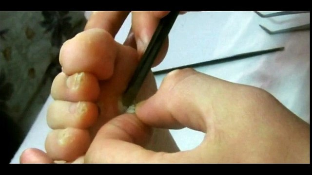 Professional Foot Care (36) Relaxing Treatment of Foot Diseases and Plantar Warts