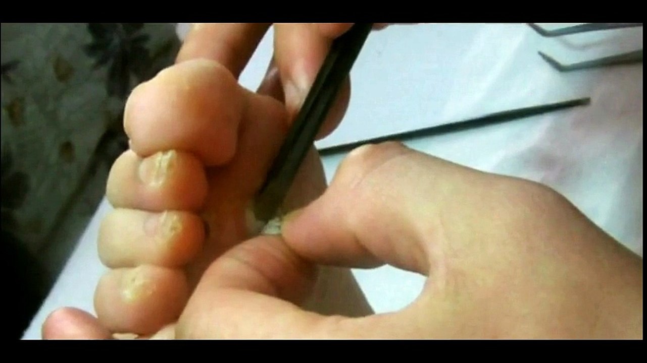 Professional Foot Care (36) Relaxing Treatment of Foot Diseases and Plantar Warts