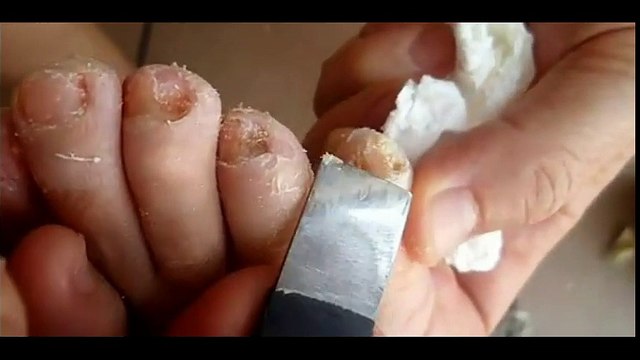 Professional Foot Care (48) Relaxing Nail Pedicure and Treatment of Nail Fungus
