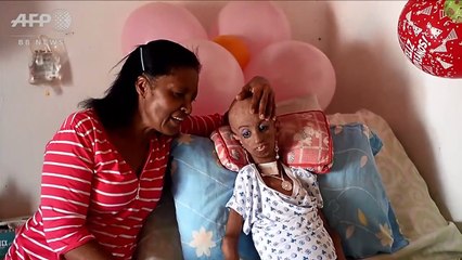 Magali jeune fille de 15 ans enfermée dans un corps de 90 ans