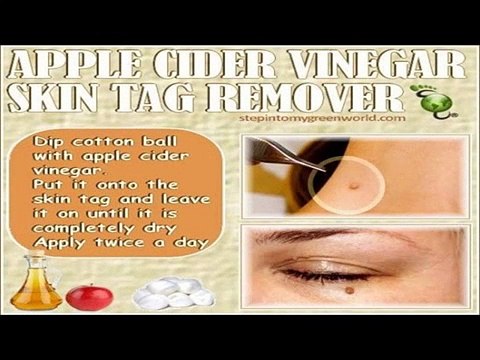 Need to Know Skin Tag Treatments That Work Fast From Home