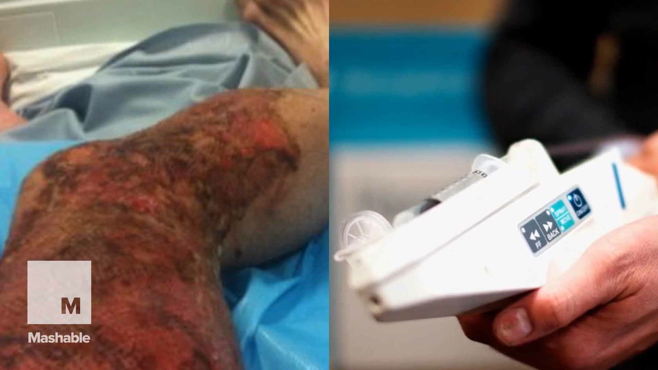This stem cell gun helps burn victims regrow their skin in just a few days