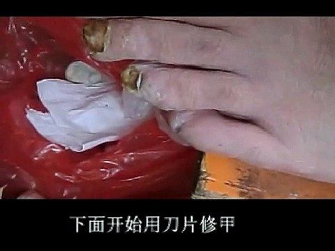 Professional Foot Care (51) Relaxing Nail Pedicure and Treatment of Nail Fungus
