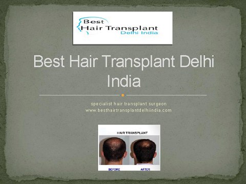 Best Hair Transplant FUE, FUT, Eyebrow Delhi, Hair Loss Treatment India
