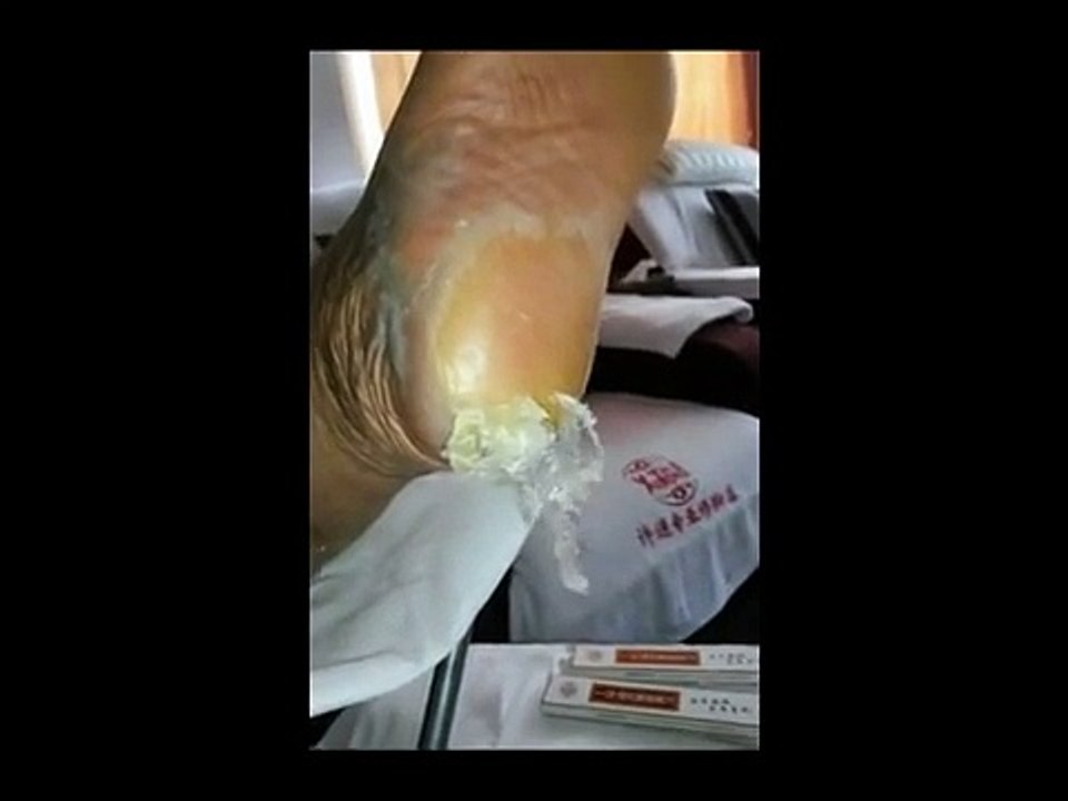 Professional Foot Care (70) Removal of Dirt and Hard Skin