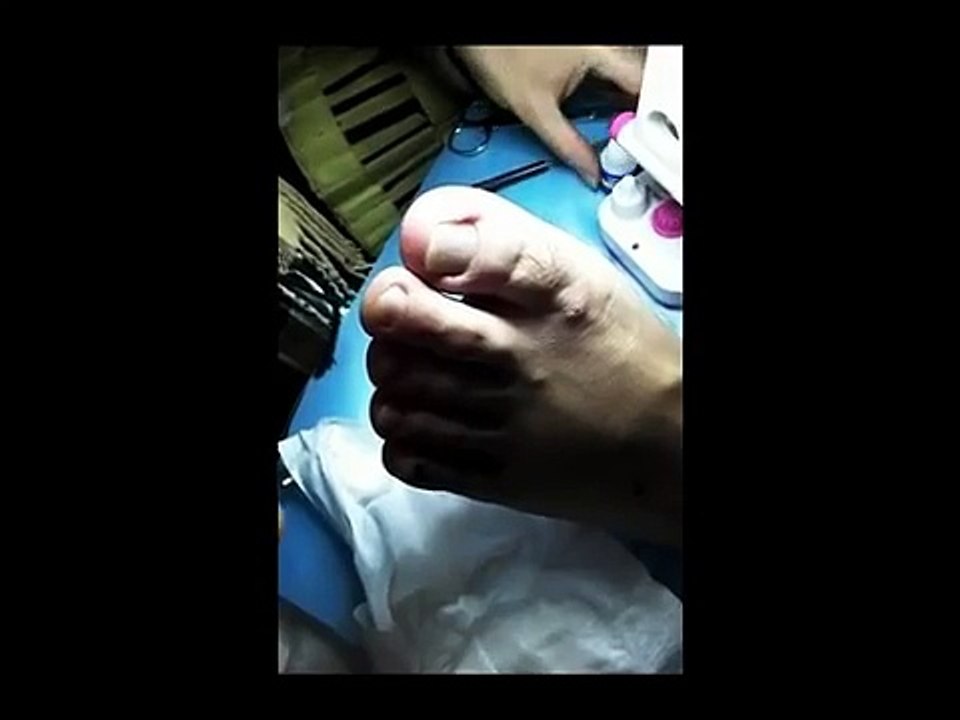 Professional Foot Care (73) Relaxing Treatment of Foot Diseases and Paronychia