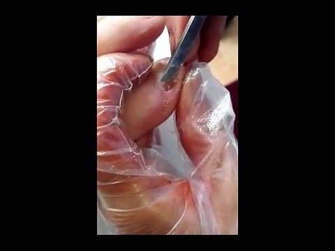 Professional Foot Care (84) Treatment of Foot Diseases and Nail Fungus