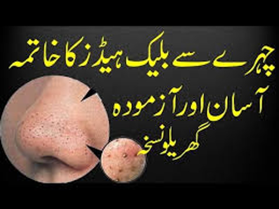 Blackhead Khatam Karne Ka Asan Gharelu Ilaj  How to Remove Blackheads From Nose & Face